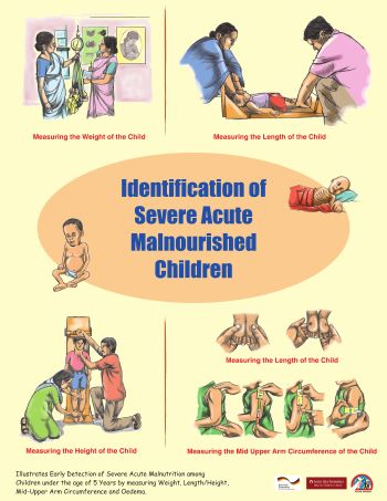 Identification of Severe Acute Malnourished Children